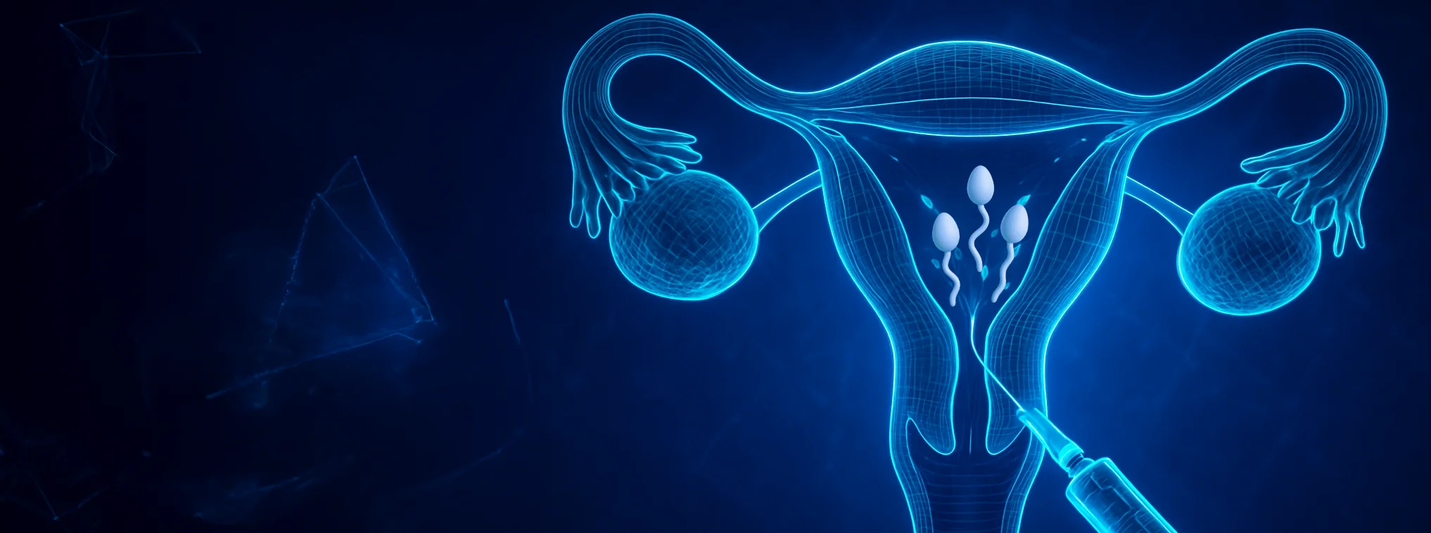 Inseminación intrauterina